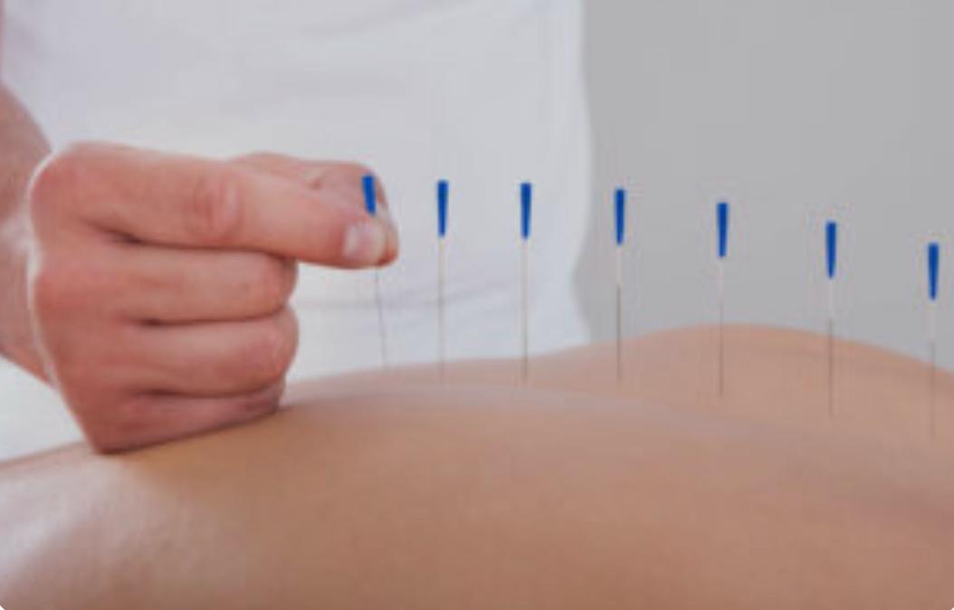 Acupuntura na Clínica Shen em Votuporanga